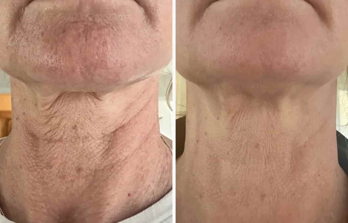 Neora Filler - Doppelpack - AKTION – Bild 3